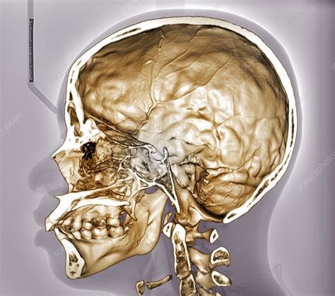 Human Skull 3d Ct Scan Stock Image C0480738 Science Photo Library