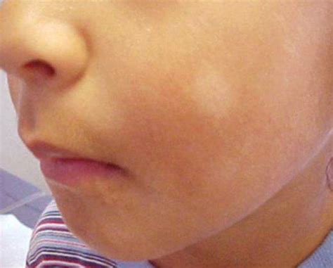 Pityriasis Alba Pictures Causes Symptoms Treatment White Skin