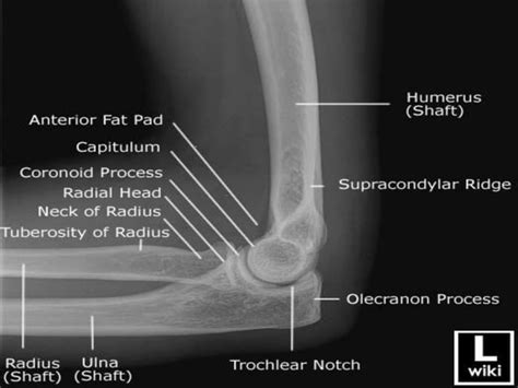 Supracondylar Fracture Of The Humerus By Phaneendra Akana Ppt