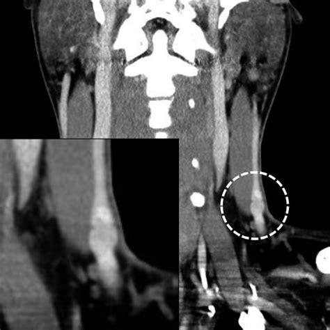 Neck Ct Preoperative Axial A Sagittal B View Of Enhanced Neck Ct
