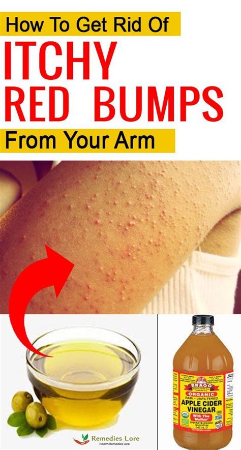 Nice Skin Chicken Skin Remedy Bumps On Arms Skin Bumps On Arms