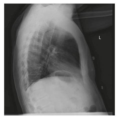 Frontal A And Lateral B Chest X Ray Images Demonstrating No