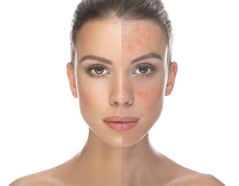 Acne Scar Healing Strategies For Sensitive Skin