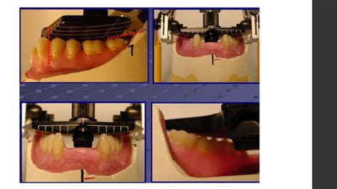 journal cub presentation on bps denture biofunctional prosthetic system