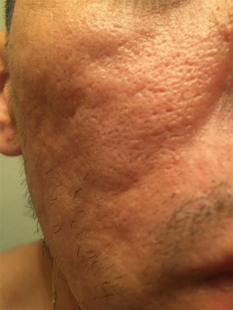 Help Please Severe Acne Scars Hypertrophic Raised Scars Acne Org Forum