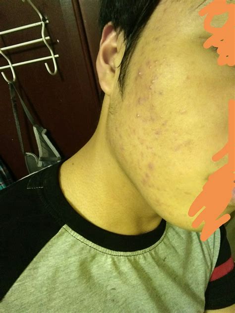 Acne How Do I Get Rid Of These Bumpy Maroonish Red Pustules
