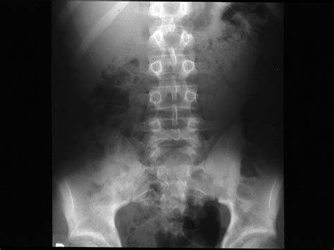 It is sometimes abbreviated to axr, or kub (for kidneys, ureters, and urinary bladder). SLIDE 28