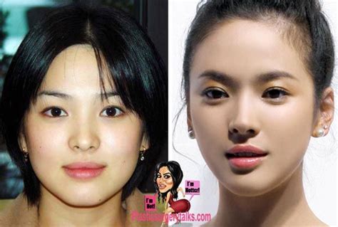 Song Hye Kyo Plastic Surgery Before And After Korean Plastic Surgery