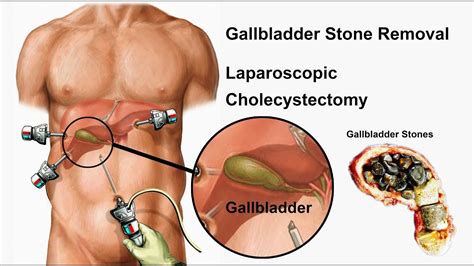Laparoscopic Gallstone Removal Surgery Laparoscopy Surgery
