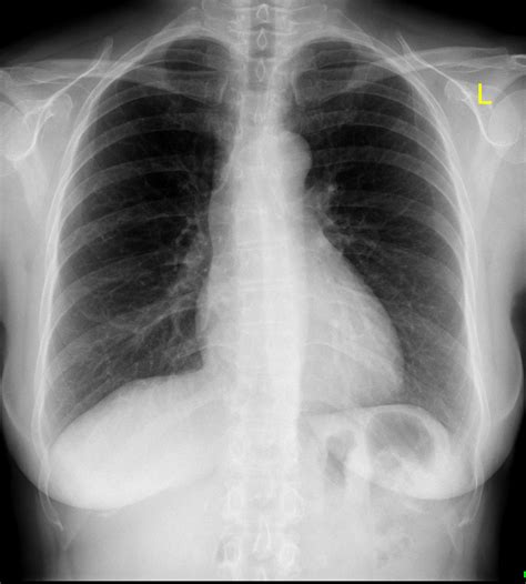 Normal Chest X Ray Radiology Case Radiopaedia Org