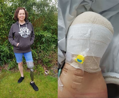 Woman Who Contracted Sepsis After Freak Accident Has To Have Leg Amputated