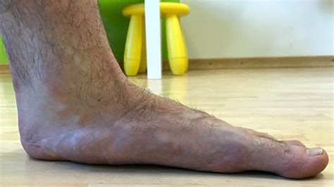 5 Ways To Treat Flat Feet Impulse Today