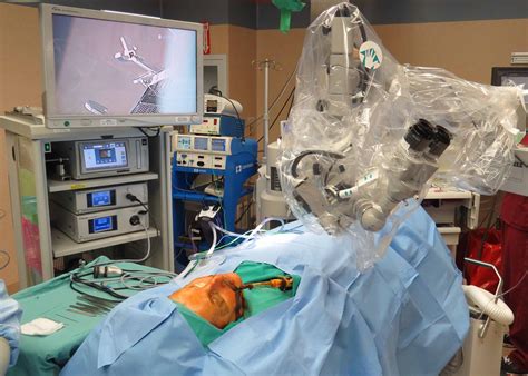 This is a video of me removing a salivary gland stone, or a sialolith, from my submandibular salivary gland (right under your tongue). Combined Open and Endoscopic Removal of Parotid Stone ...