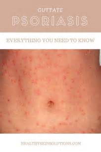 Guttate Psoriasis Everything You Need To Know Plaque Psoriasis