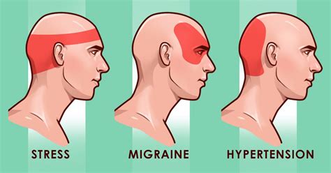 7 Points That Soothe Headaches