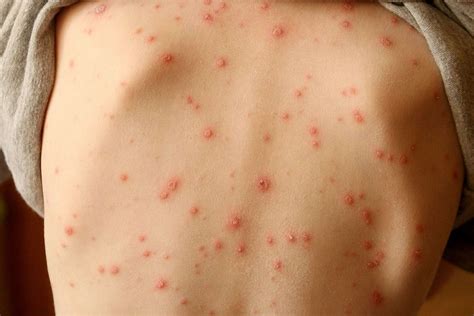 Skin Rash Should Be Considered Key Symptom Of Coronavirus Say Scientists