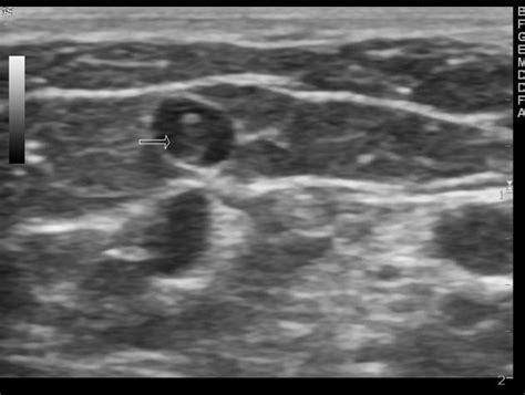 La trombosis venosa profunda (tvp) se define como la formación de un coágulo de sangre dentro del sistema venoso profundo que ocurre con mayor frecuencia en los miembros inferiores, pero también puede ocurrir en otros lugares como brazos y abdomen2. Trombosis Venosa Superficial | Centro vascular y endovascular
