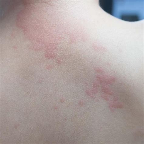 Urticaire Allergique Définition Cause Symptômes Traitement