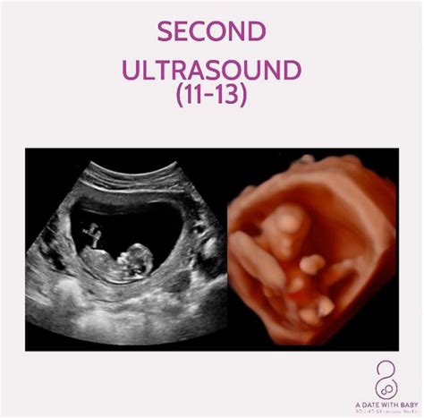 10 Week Ultrasound Pictures 2023