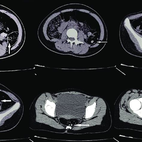 Abdominopelvic Computed Tomography Ct Scan Of A Girl With