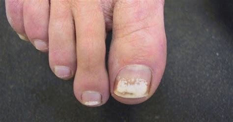 White Spots On Toenails From Nail Polish Nails Magazine