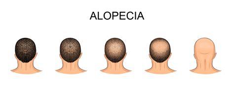Causes And Treatments Of Hair Loss From Alopecia Areata