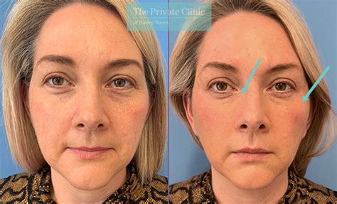 Tear Trough Filler Uk Non Surgical Blepharoplasty London Harley Street