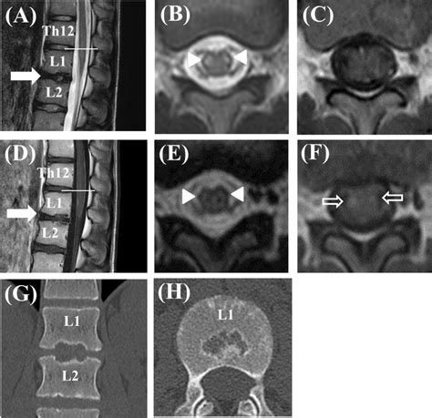 Fibrocartilaginous Embolism Of The Spinal Cord In Children A Case