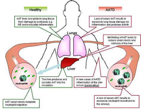Figure 2 from Alpha-1 Antitrypsin: A Potent Anti-Inflammatory and ...
