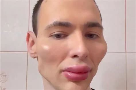 Plastic Surgery Obsessed Ex Russian Soldier Popeye Becomes An Alien