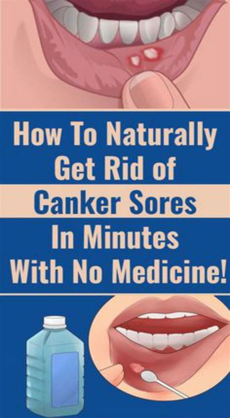 How To Cure Canker Sores And Mouth Sores Healthpinspopular