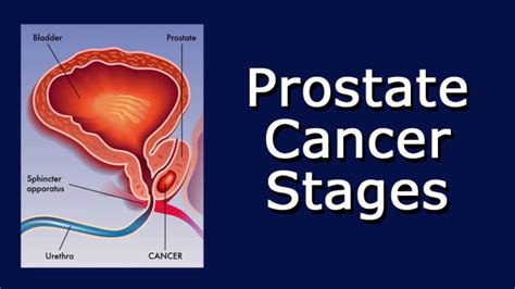 Prostate Cancer Stages Youtube