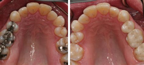 Restorative Dental Care Columbus Indiana Tooth Restorations