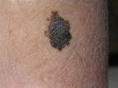 Stage Two Melanoma Symptoms Doctor Heck