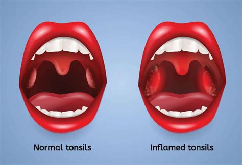 Normal Vs Swollen Tonsils