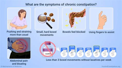 Slide Show Understanding Chronic Constipation