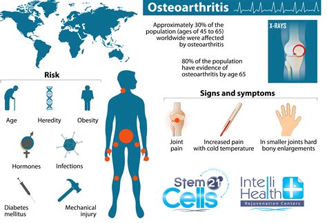 Rheumatoid Arthritis Treatment Adult Stem Cell Therapy Abroad Stem
