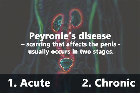 Peyronie S Disease Urology Clinic P C