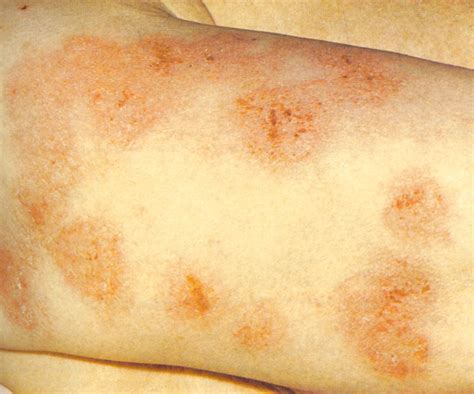 Nummular Eczema Causes Symptoms Treatment Pictures Diseases Pictures
