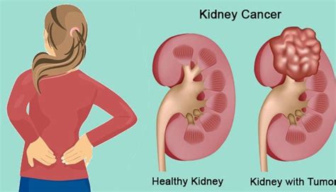 Kidney Cancer Awareness Month Know All About The Disease Odishabytes