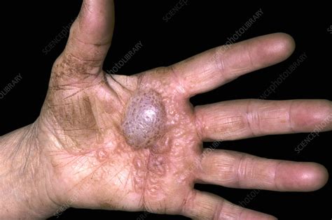 Dyshidrosis Of The Hands Stock Image C0459529 Science Photo Library