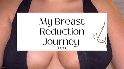 My Breast Reduction Journey At 21 Dr Ary Krau Youtube