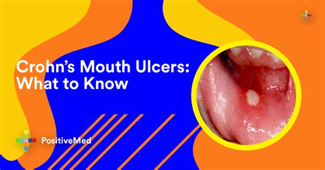 What You Need To Know About Crohns Mouth Ulcers Positivemed