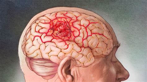 Tumor Cerebral Maligno O Cáncer De Cerebro Qué Es Síntomas Y Más