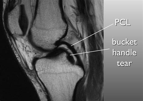 Double Pcl Sign Appears On Sagittal Mri Images Of The Knee When A