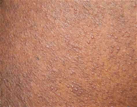Perifollicular Papules On The Trunk Mdedge Dermatology