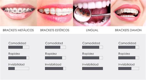 Tipos De Brackets Para Ortodoncia Druiz Instituto Médico Dental