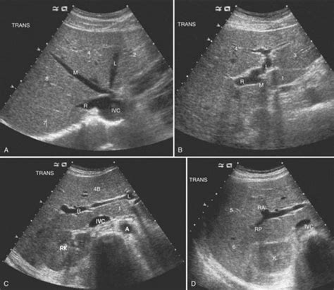Liver Vascularity Medical Ultrasound Ultrasound Ultrasound Sonography