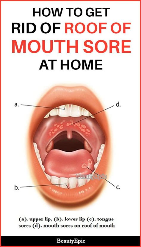 Simple Ways To Get Rid Of Roof Of Mouth Sore At Home Mouth Sores