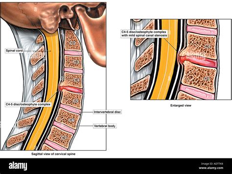 Coluna Cervical C3-c4 C5-c6